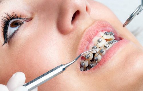 braces-orthodontics ortho